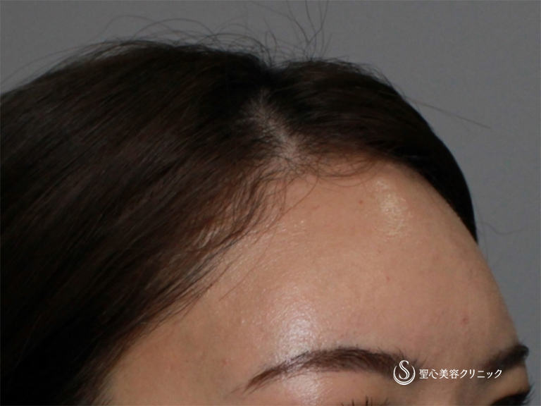 【20代女性・額の凹みを改善してふっくらさせたい】額のプレミアムPRP（1か月後） After 