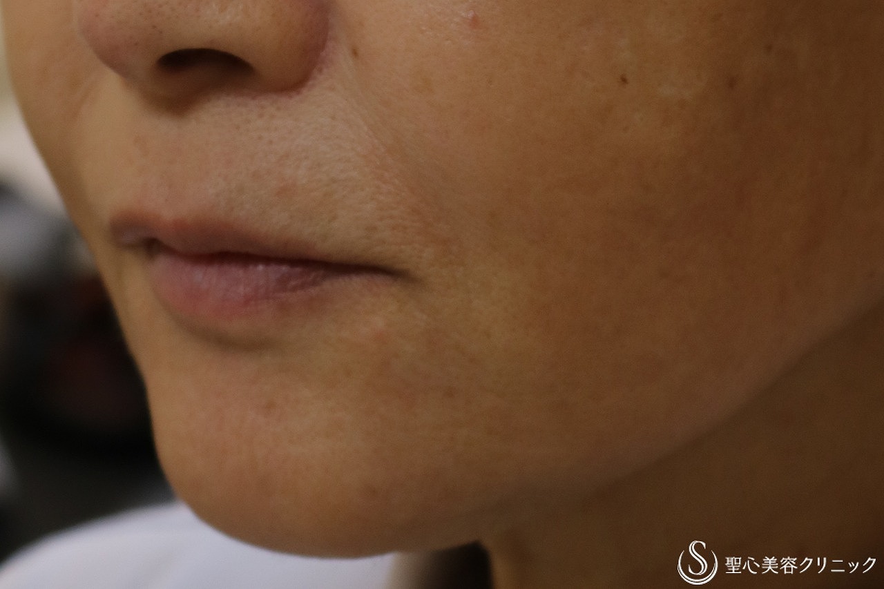 【60代女性・ほうれい線、目の下のくぼみ、額】プレミアムPRP皮膚再生療法（6ヶ月後） After 