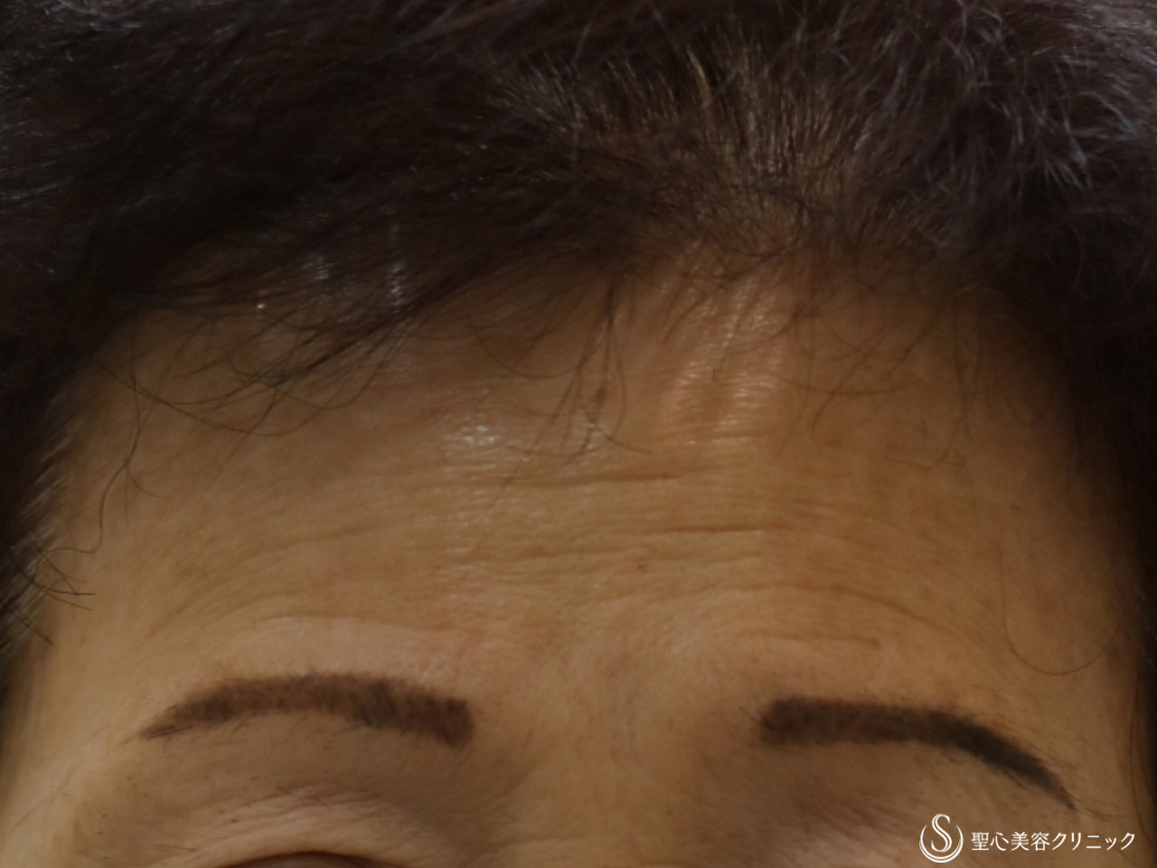 【60代女性・ほうれい線、目の下のくぼみ、額】プレミアムPRP皮膚再生療法（6ヶ月後） Before 