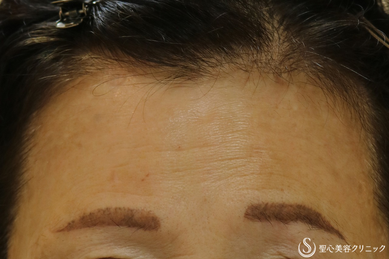【60代女性・ほうれい線、目の下のくぼみ、額】プレミアムPRP皮膚再生療法（6ヶ月後） After 
