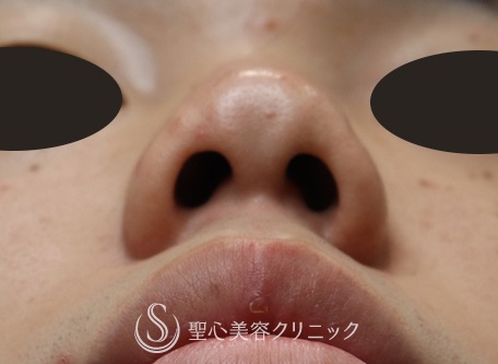 【20代男性・鼻先の溝を改善】鼻割れ修正（1ヶ月後） Before 