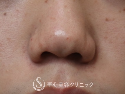 【20代男性・鼻先の溝を改善】鼻割れ修正（1ヶ月後） Before 