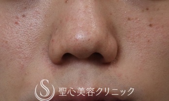 【20代男性・鼻先の溝を改善】鼻割れ修正（1ヶ月後） After 