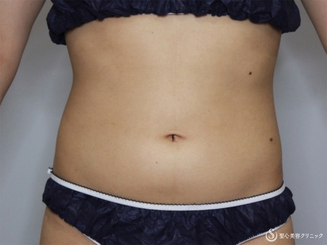 【20代女性・腹部をスッキリ】リポセル（1ヶ月後） Before 