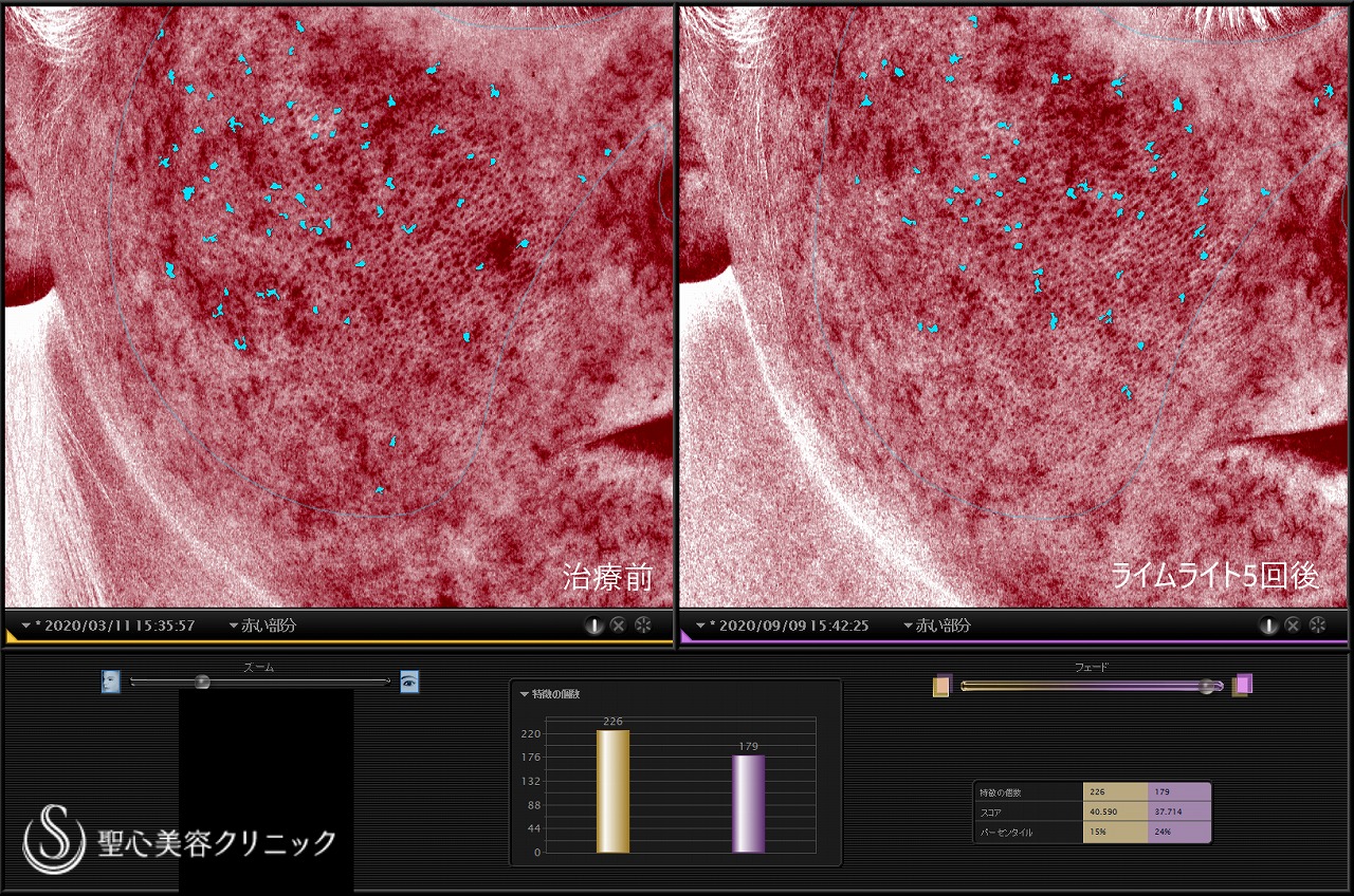 【30代女性・顔の赤みを改善】ライムライト（照射5回） After 