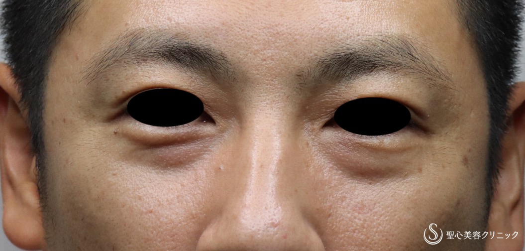 【40代男性・切らない目の下のクマ治療】プレミアムPRP皮膚再生療法（10ヶ月後） Before 