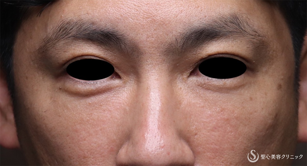 【40代男性・切らない目の下のクマ治療】プレミアムPRP皮膚再生療法（10ヶ月後） After 