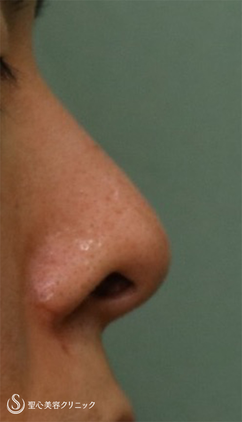 【30代男性・鼻の穴を目立たなくしたい】鼻孔縁下降術（1ヶ月後） Before 