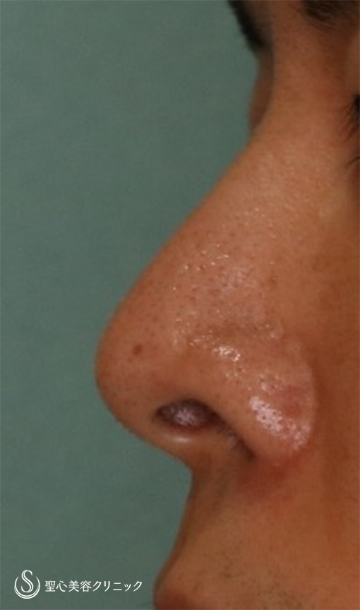 【30代男性・鼻の穴を目立たなくしたい】鼻孔縁下降術（1ヶ月後） After 