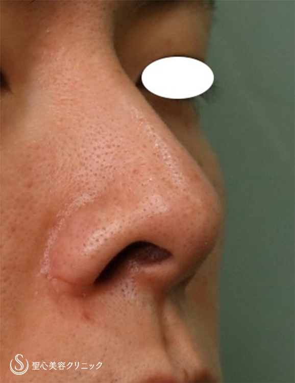 【30代男性・鼻の穴を目立たなくしたい】鼻孔縁下降術（1ヶ月後） Before 