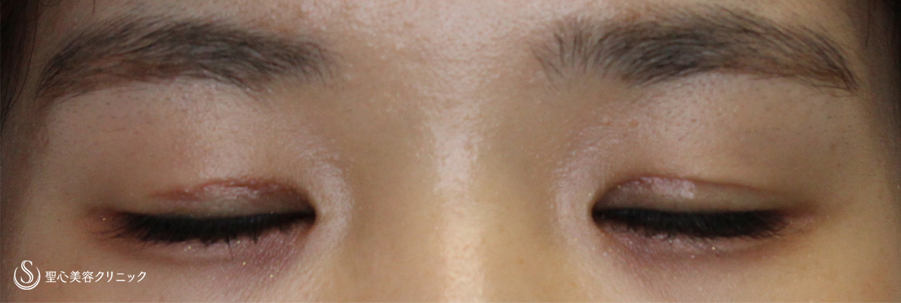 【20代女性・二重でハッキリとした瞼に】二重切開手術（1ヶ月後） After 