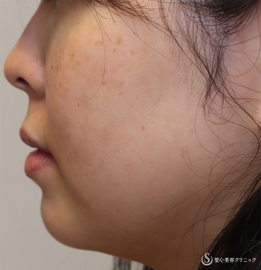【30代女性・頬と顎下を細く】頬・顎下の脂肪吸引（3ヶ月後） Before 
