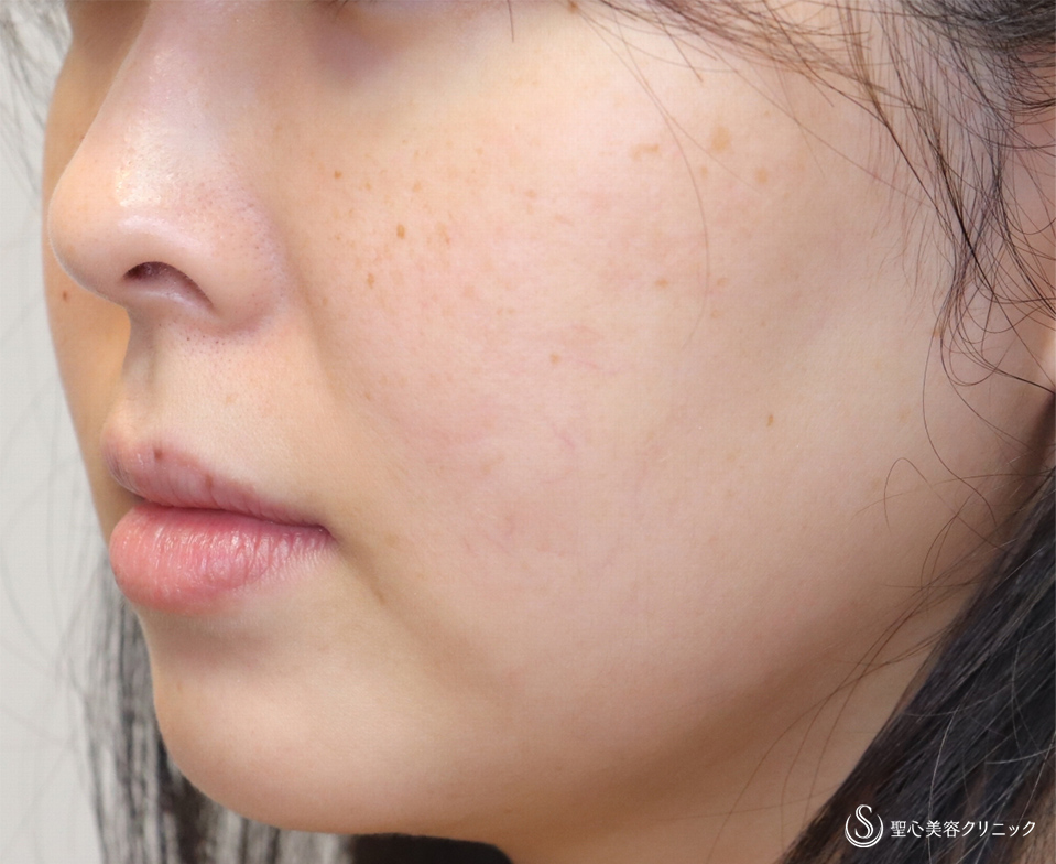 【30代女性・頬と顎下を細く】頬・顎下の脂肪吸引（3ヶ月後） Before 