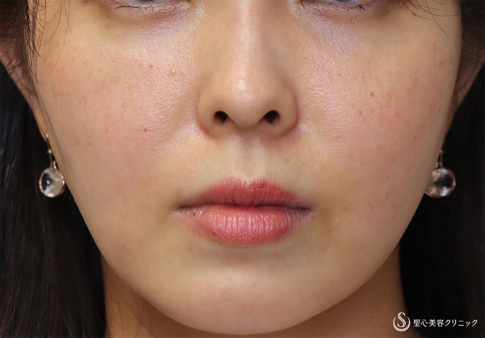 【30代女性・頬と顎下を細く】頬・顎下の脂肪吸引（3ヶ月後） After 