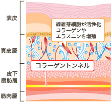 線維芽細胞が活性化 エラスニンを増殖 コラーゲントンネル