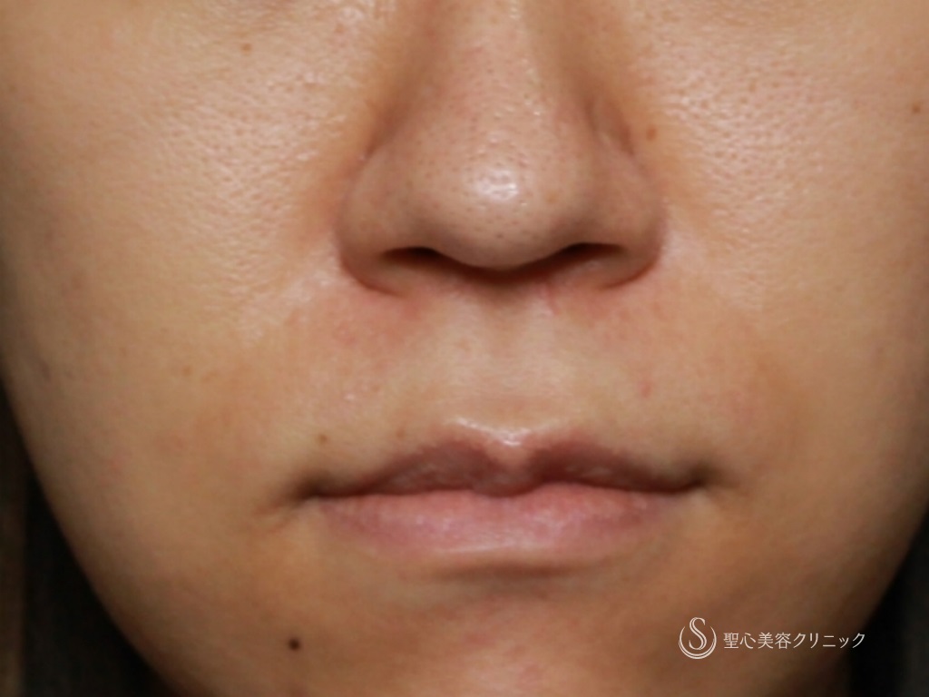 代女性 鼻先と鼻頭をスッキリ バランスよく 鼻尖縮小 鼻柱耳介軟骨移植 1ヶ月後 症例写真 美容整形 美容外科なら聖心美容クリニック