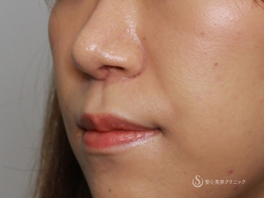 【20代女性・鼻先と鼻頭をスッキリ、バランスよく】鼻尖縮小+鼻柱耳介軟骨移植（1ヶ月後） After 