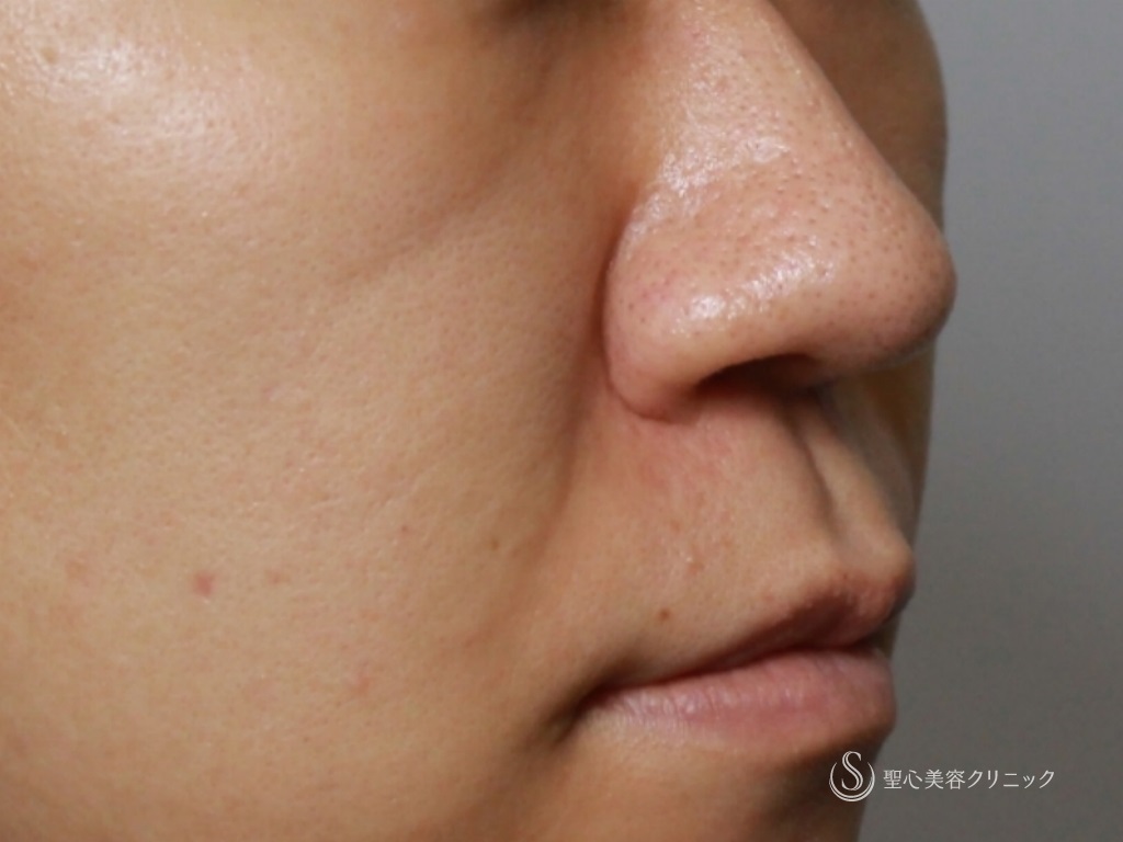【20代女性・鼻先と鼻頭をスッキリ、バランスよく】鼻尖縮小+鼻柱耳介軟骨移植（1ヶ月後） Before 
