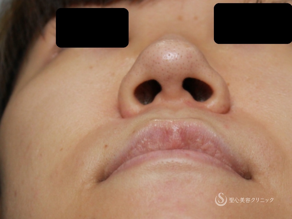 【20代女性・鼻先と鼻頭をスッキリ、バランスよく】鼻尖縮小+鼻柱耳介軟骨移植（1ヶ月後） Before 