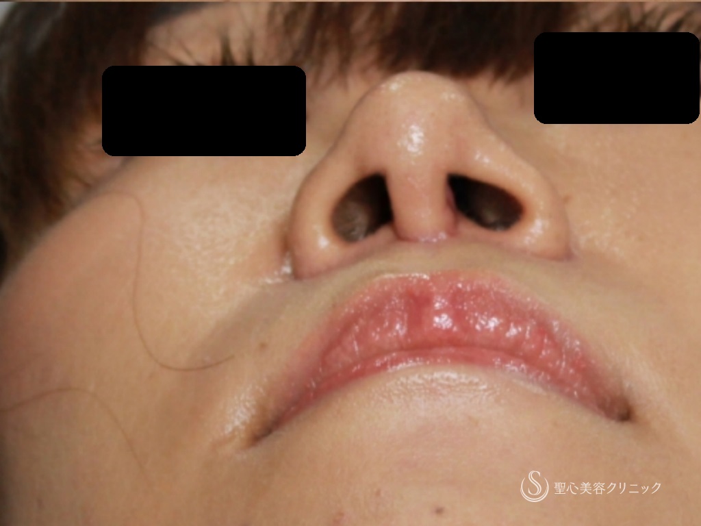 【20代女性・鼻先と鼻頭をスッキリ、バランスよく】鼻尖縮小+鼻柱耳介軟骨移植（1ヶ月後） After 