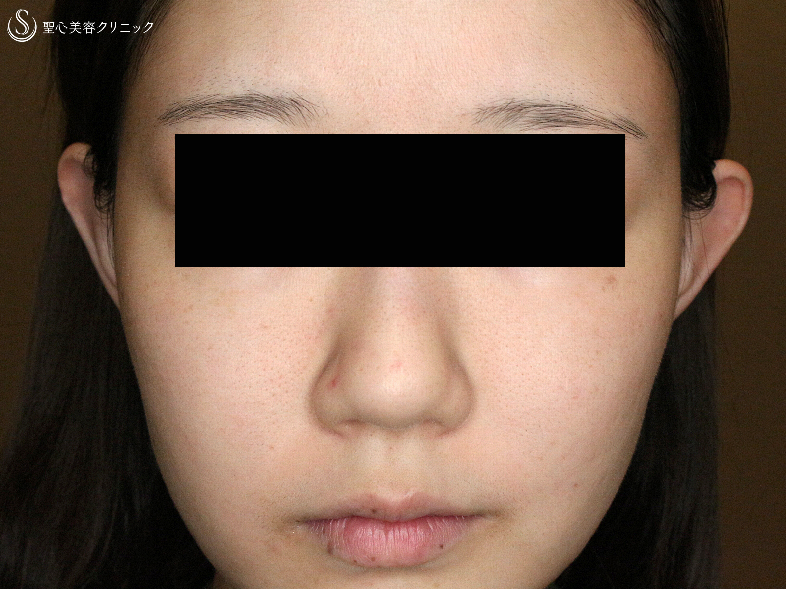 【20代女性・赤ら顔の治療】585 Quanta System Q1モニター（3回後） After 