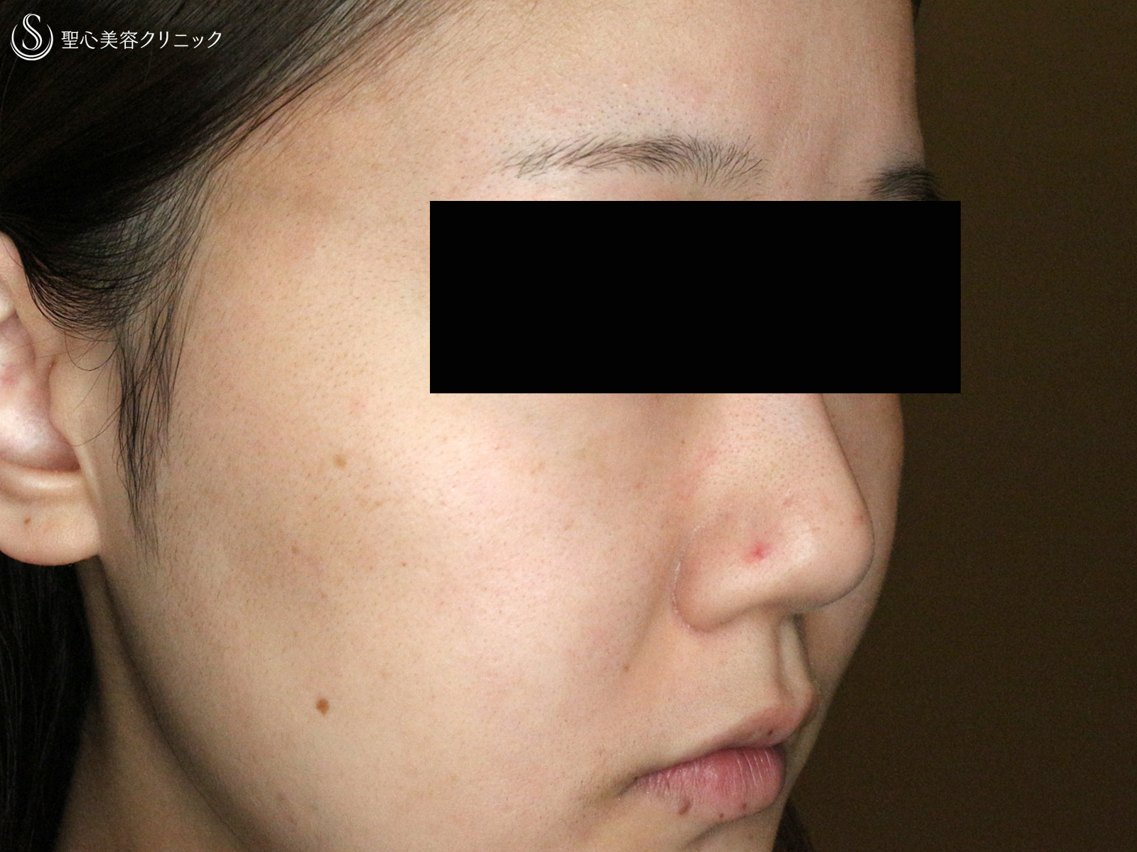 【20代女性・赤ら顔の治療】585 Quanta System Q1モニター（3回後） After 