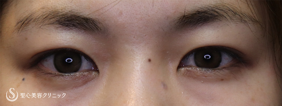 【20代女性・蒙古襞を減らす】目頭切開手術（1ヶ月後） Before 
