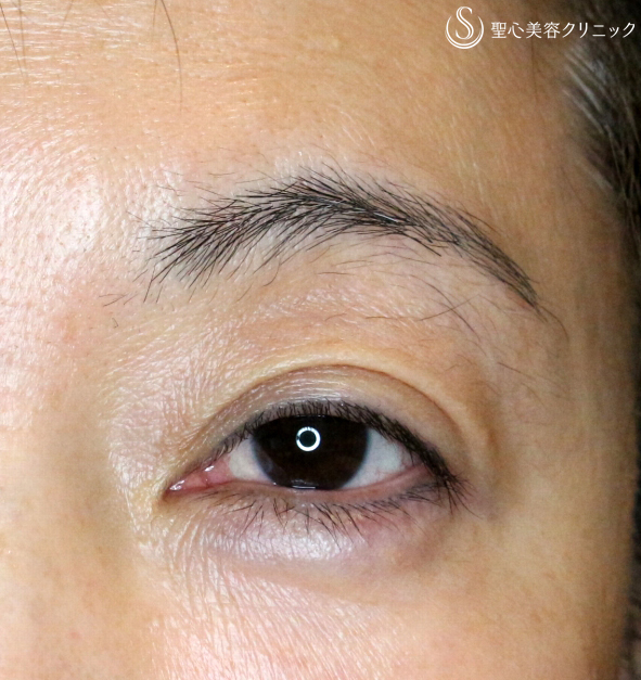 50代女性 長期経過 切らない眼瞼下垂 A法 4年6ヶ月 症例写真 美容整形 美容外科なら聖心美容クリニック