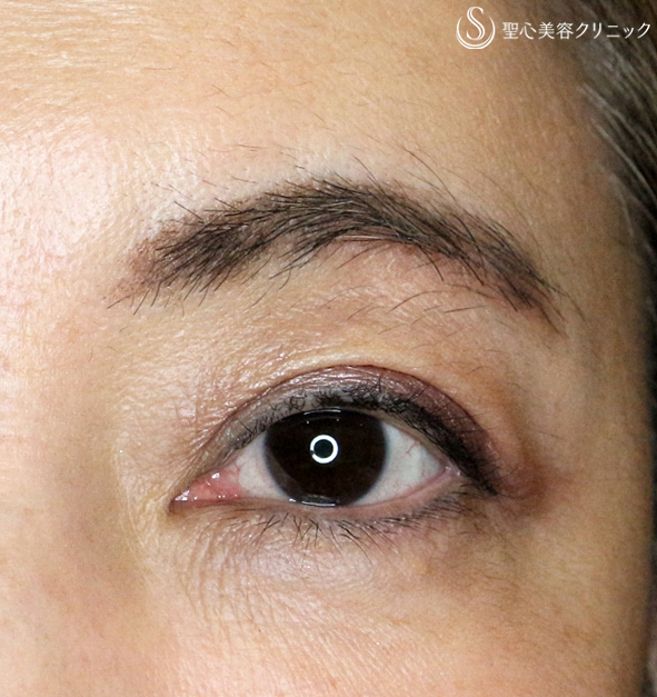【50代女性・長期経過】切らない眼瞼下垂+α法（4年6ヶ月） After 