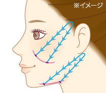 こめかみ・上頬・口元・アゴ下までしっかりとリフトアップ