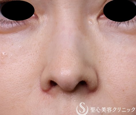 【50代女性・鼻孔をおさまりよく】小鼻縮小術（1ヶ月半後） After 