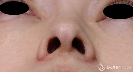 【50代女性・鼻孔をおさまりよく】小鼻縮小術（1ヶ月半後） After 