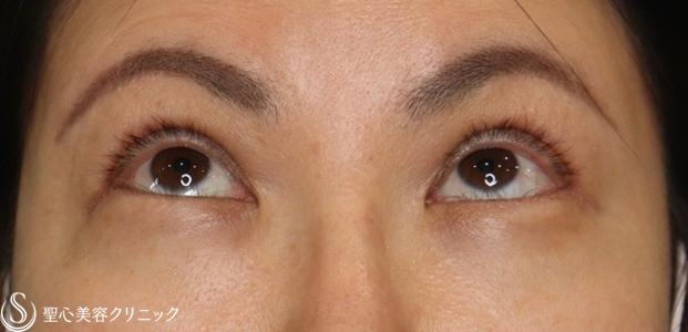 【40代女性・目元をパッチリ】眼瞼下垂症手術＋眉下切開（2ヶ月後） Before 