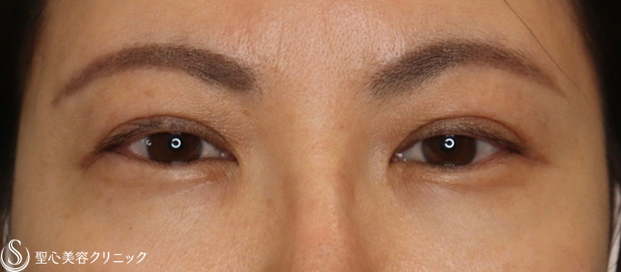 【40代女性・目元をパッチリ】眼瞼下垂症手術＋眉下切開（2ヶ月後） Before 