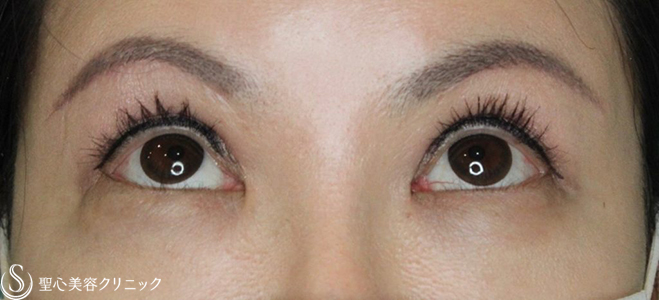 【40代女性・目元をパッチリ】眼瞼下垂症手術＋眉下切開（2ヶ月後） After 