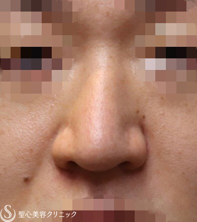 【30代男性・厚ぼったいお鼻もスッキリ】小鼻縮小術＋鼻尖縮小術（4ヶ月後） After 