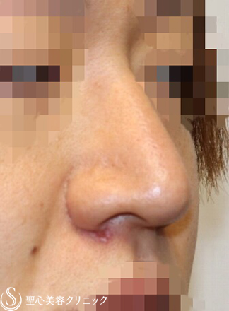 【30代男性・厚ぼったいお鼻もスッキリ】小鼻縮小術＋鼻尖縮小術（4ヶ月後） After 