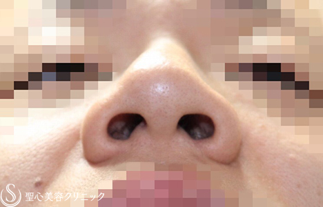 【30代男性・厚ぼったいお鼻もスッキリ】小鼻縮小術＋鼻尖縮小術（4ヶ月後） Before 
