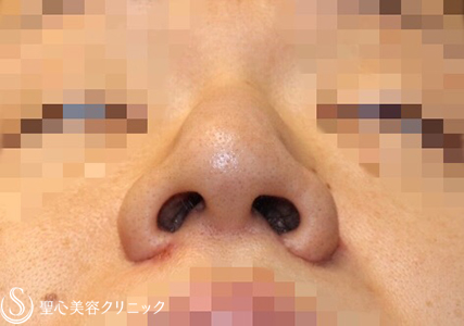 【30代男性・厚ぼったいお鼻もスッキリ】小鼻縮小術＋鼻尖縮小術（4ヶ月後） After 