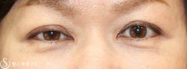 【50代女性・目の左右差を綺麗に】眼瞼下垂症手術（右側のみ：切開法）（1ヶ月後） Before 