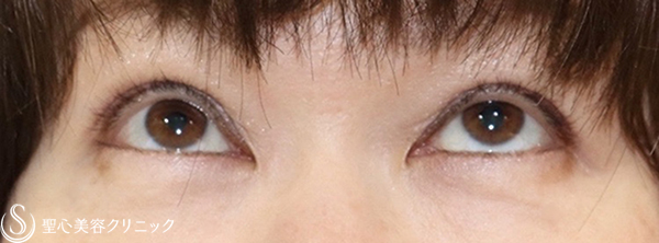 【50代女性・目の左右差を綺麗に】眼瞼下垂症手術（右側のみ：切開法）（1ヶ月後） After 