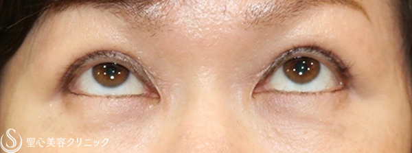 【50代女性・目の左右差を綺麗に】眼瞼下垂症手術（右側のみ：切開法）（1ヶ月後） Before 
