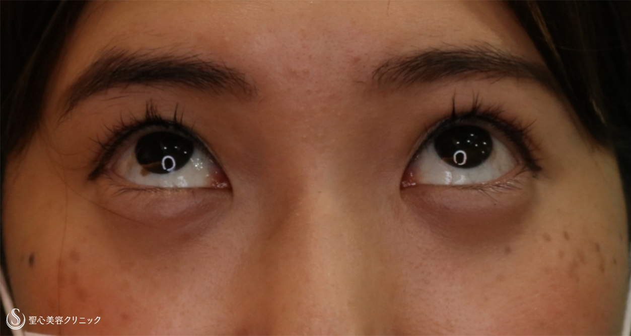 【20代女性・眠そうな目をぱっちりに】眼瞼下垂 埋没法（4ヵ月後） After 