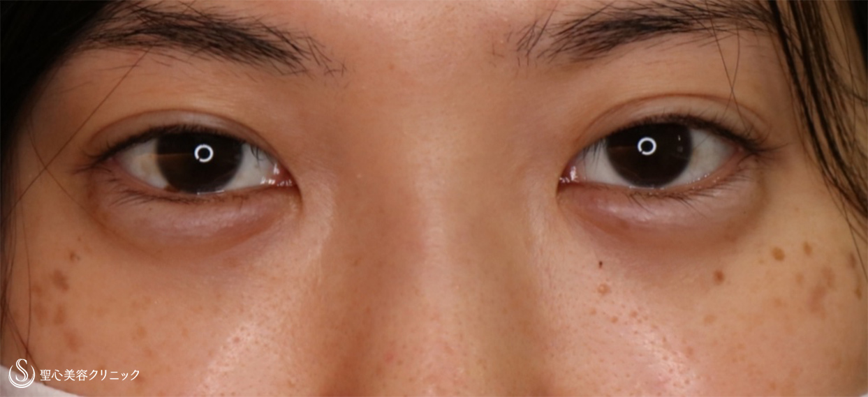 【20代女性・眠そうな目をぱっちりに】眼瞼下垂 埋没法（4ヵ月後） Before 