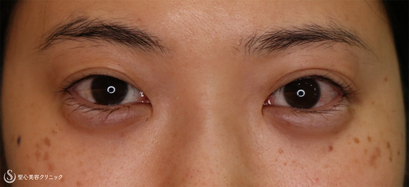【20代女性・眠そうな目をぱっちりに】眼瞼下垂 埋没法（4ヵ月後） After 