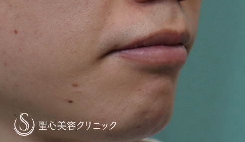 【20代男性・唇を薄く】口唇縮小術（1週間後） After 