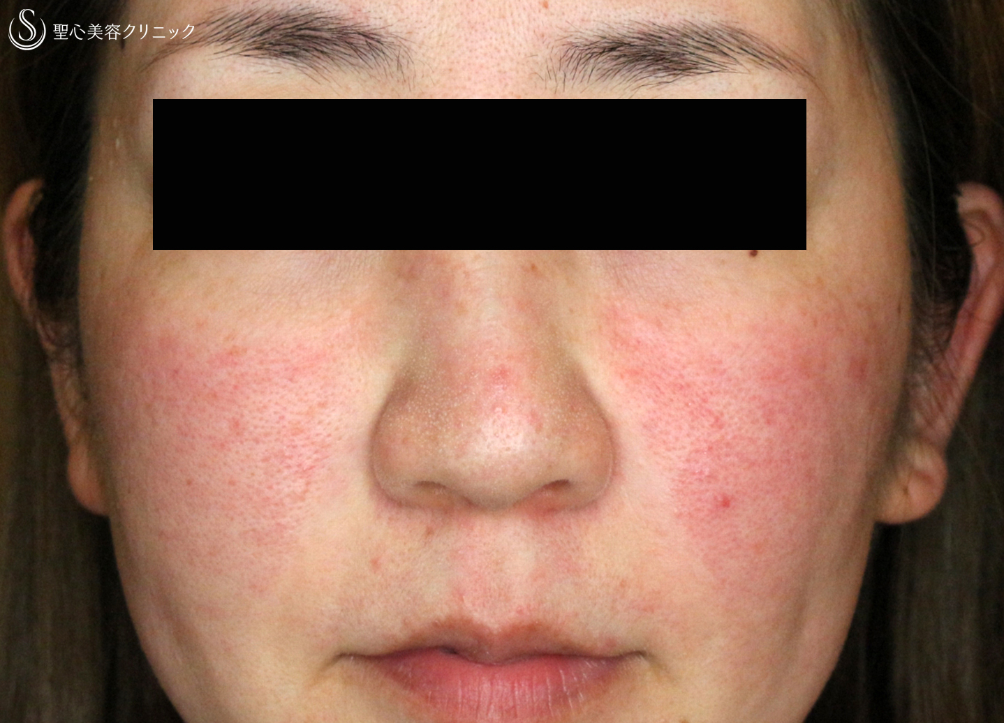 【30代女性・赤ら顔の治療】585 Quanta System Q1モニター（2回後） Before 