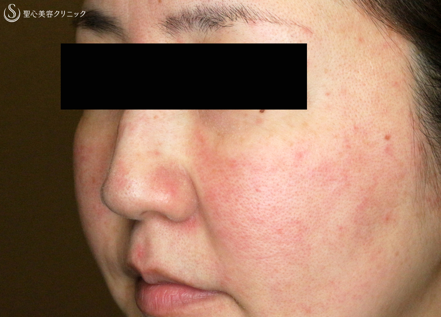 【30代女性・赤ら顔の治療】585 Quanta System Q1モニター（2回後） After 