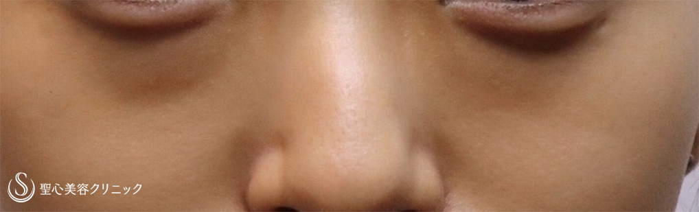 【20代女性・注入治療だけで目の下のクマ改善】プレミアムPRP皮膚再生療法 （6ヶ月後） Before 