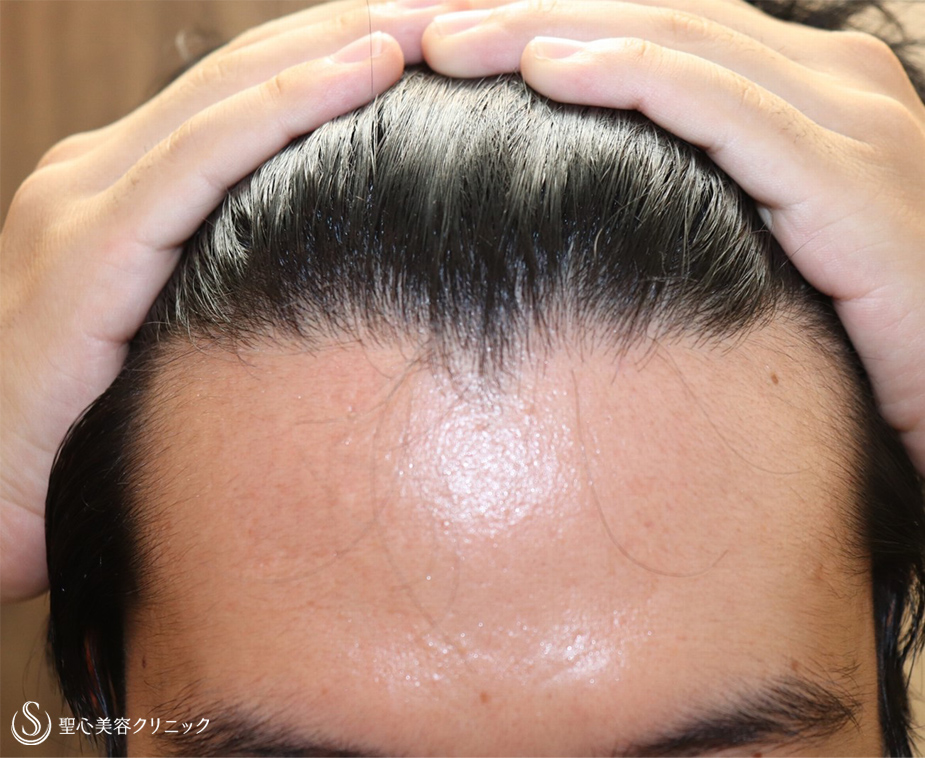 【20代男性・髪の毛の悩みは王道コースで解決】プレミアムグロースファクター再生療法＋アボルブ・ミノキシジル内服（半年後） After 